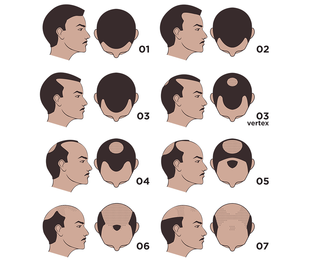 norwood scale